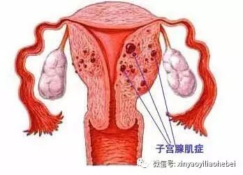 子宫腺肌症最新治疗探索，前沿技术与有效疗法概览