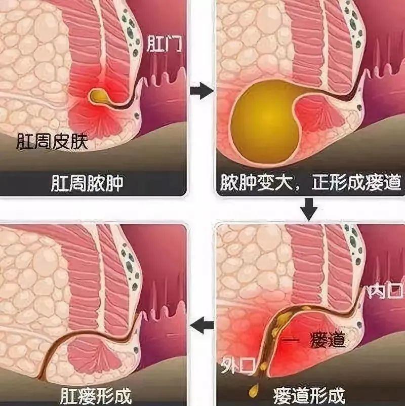 肛瘘最新治疗方法概述